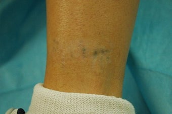 Ankle Tattoo, before, 4 treatments and 11 treatments with 1064 MedLite YAG Laser