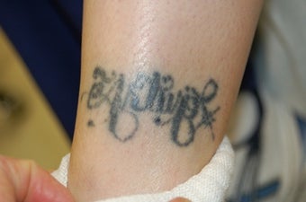 Ankle Tattoo, before, 4 treatments and 11 treatments with 1064 MedLite YAG Laser