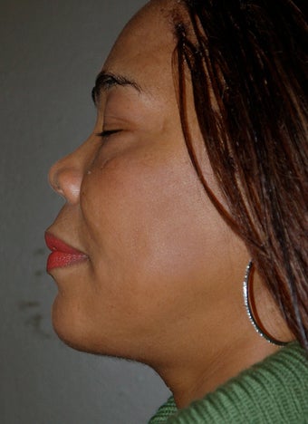 Chin Surgery, Chin Augmentation, Double Chin