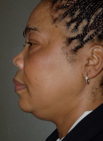 Chin Surgery, Chin Augmentation, Double Chin