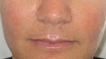 39 year old undergoing fillers to her nasolabial folds