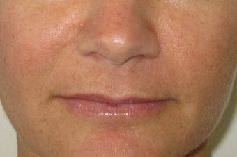 39 year old undergoing fillers to her nasolabial folds