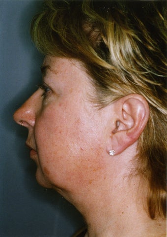 Liposuction - Lower Face - Lower Eyelid - Upper Neck