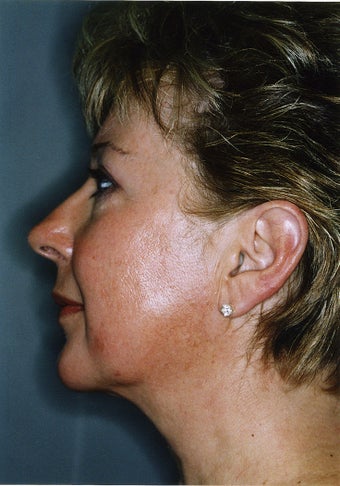 Liposuction - Lower Face - Lower Eyelid - Upper Neck