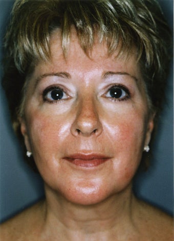 Liposuction - Lower Face - Lower Eyelid - Upper Neck