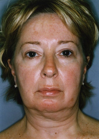 Liposuction - Lower Face - Lower Eyelid - Upper Neck