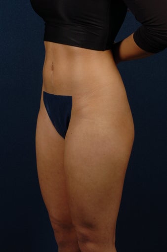 20 Year Old Female - Gluteal Augmentation