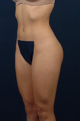 20 Year Old Female - Gluteal Augmentation
