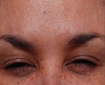 Female Treated for Forehead Wrinkles