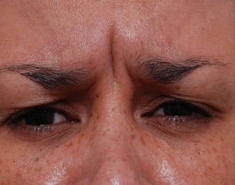 Female Treated for Forehead Wrinkles