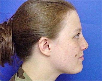 Septorhinoplasty