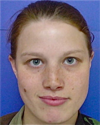 Septorhinoplasty