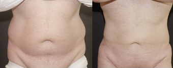 Liposculpture