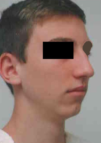 Chin Implant