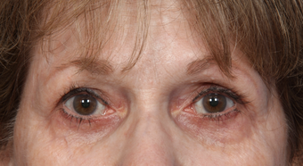 Eyelid Surgery