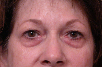 Eyelid Surgery