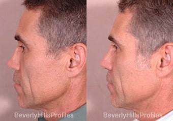 Revision Rhinoplasty