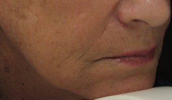 Marionette Line after Treatment with Juvederm Ultra Plus Injection gel