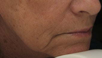 Marionette Line after Treatment with Juvederm Ultra Plus Injection gel