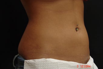 Coolsculpting