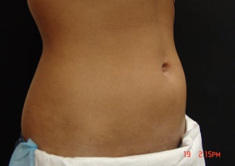 Coolsculpting