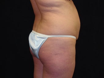 Brazilian Buttocks Lift 