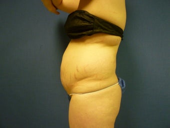Liposuction of Abdomen and Waist
