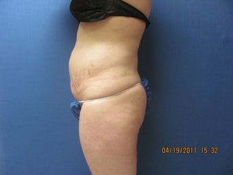 Liposuction of Abdomen and Waist