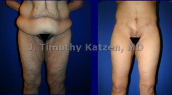 Leg Lift after weight loss surgery