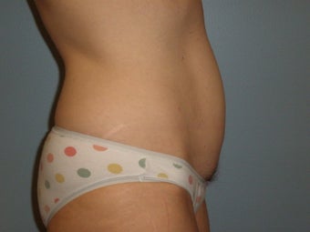 Mini Tummy Tuck 