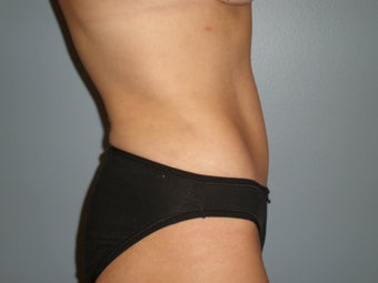 Mini Tummy Tuck 