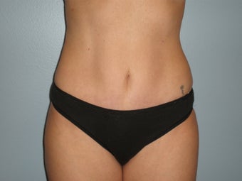 Mini Tummy Tuck 
