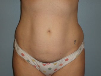 Mini Tummy Tuck 