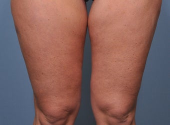 35 Year Old Female Treated For Abdominal and Thigh Skin Excess