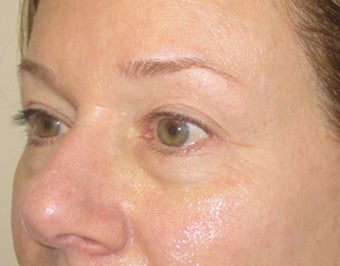 46 year old with eyelid bags undergoing filler treatment