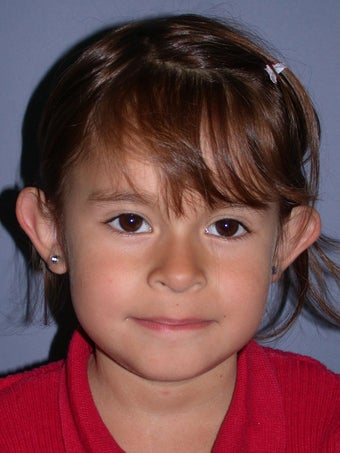 Otoplasty/Ear Surgery