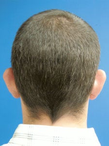 Otoplasty Ear Surgery - Male