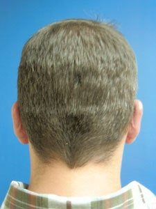 Otoplasty Ear Surgery - Male
