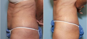 56 year old female with abdominal laxity