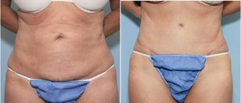 56 year old female with abdominal laxity