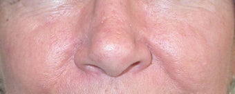 53 year old Female with Facial Veins / Telangiectasia