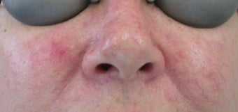53 year old Female with Facial Veins / Telangiectasia