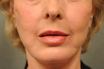 64 Year Old Female with Deep Lip Lines and Asymmetry to Lips