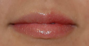 Juvederm in Lips