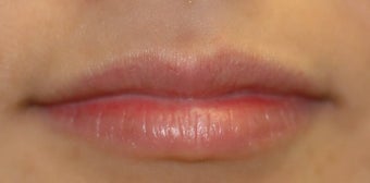 Juvederm in Lips