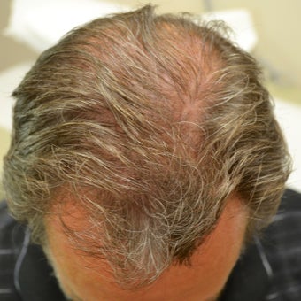 53 year old male before and after 1 year on Propecia
