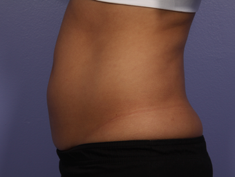 CoolSculpting by Zeltiq to Abdomen