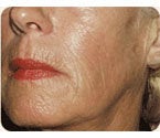 Sculptra