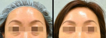 Lower Eyelid(Blepharoplasty) Surgery