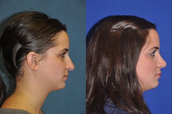 Rhinoplasty